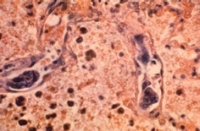 Group of cancer cells