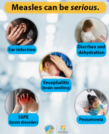 Five photos showing complications of measles including ear infection, dehydration and diarrhea, encephailitis or brain swelling, SSPA or brain disorder and pneumonia