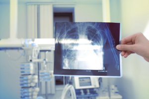 A hand holding up a chest X-ray film showing a rib cage and lungs in a bright clinical room with medical equipment in the background.
