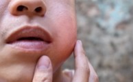 A person with a puffy cheek from being infected with mumps.