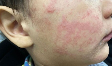 A person with a measles rash on their face.